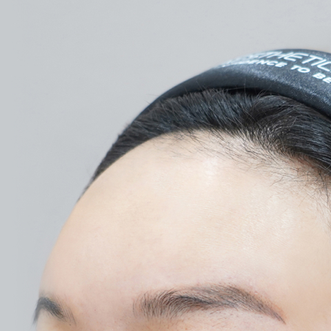 Lienjang forehead filler after mobile image 1