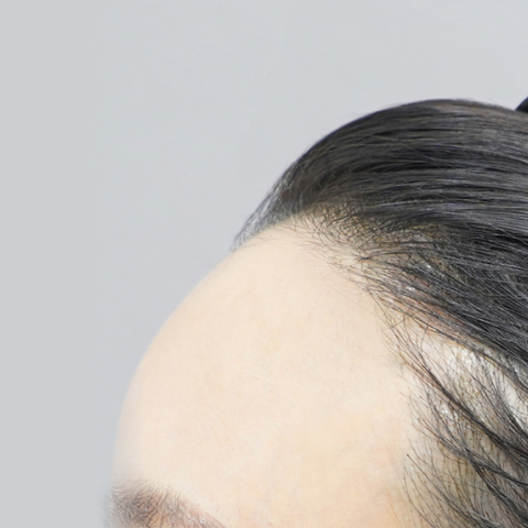 Lienjang forehead filler after mobile image 2