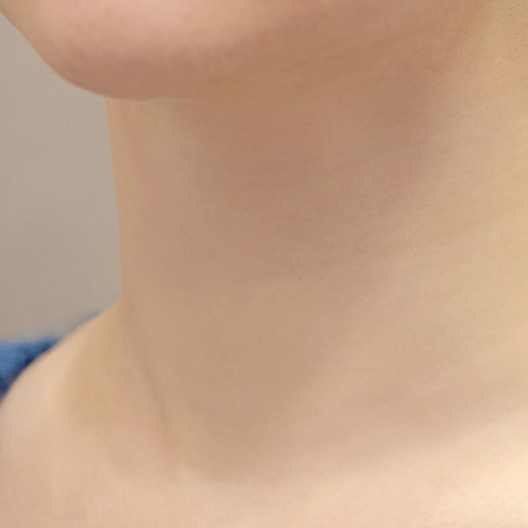 Lienjang neck wrinkle filler after mobile image