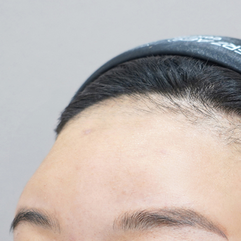 Lienjang forehead filler before mobile image 1