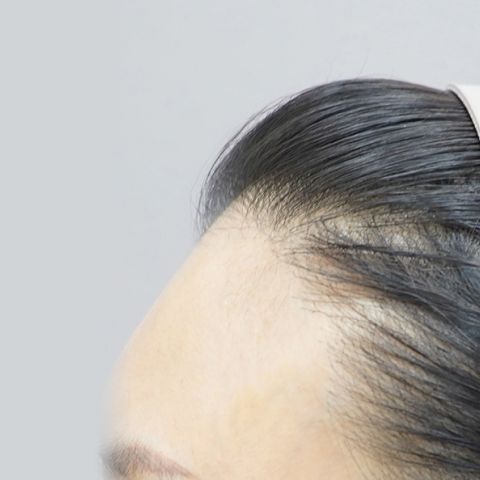 Lienjang forehead filler before mobile image 2