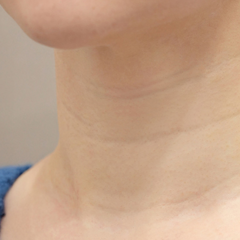 Lienjang neck wrinkle filler before mobile image