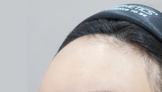 Lienjang forehead filler after image 1