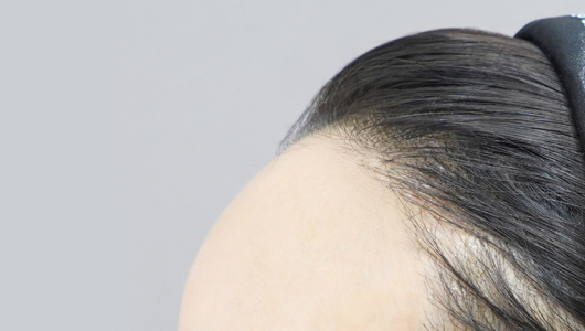 Lienjang forehead filler after image 2