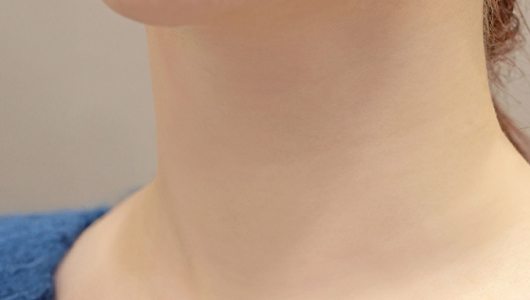 Lienjang neck wrinkle filler after image