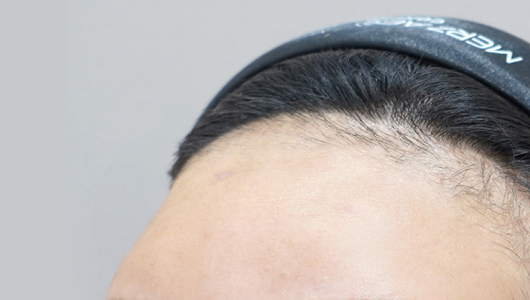 Lienjang forehead filler before image 1