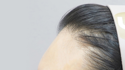 Lienjang forehead filler before image 2
