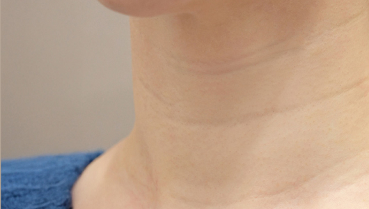 Lienjang neck wrinkle filler before image