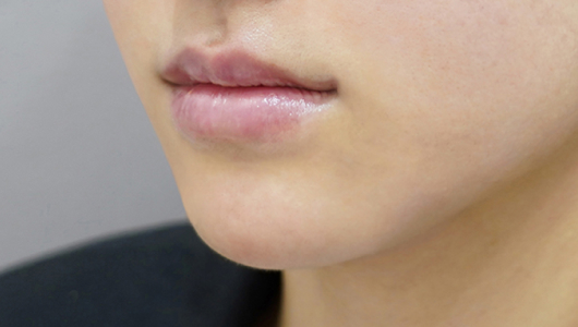 after filler treatment for thin lips