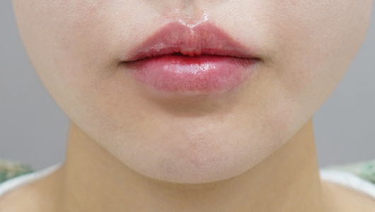 after filler treatment for downturned lips