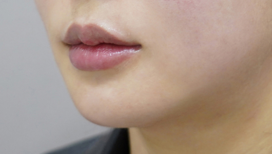 after filler treatment for uneven lips
