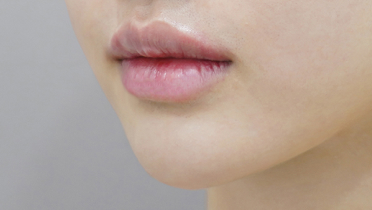 after filler treatment for small lips