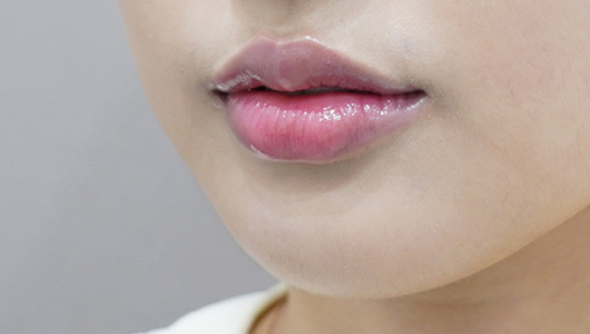 after filler treatment for curled-in lips