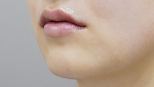 after filler treatment for a long philtrum