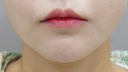 before filler treatment for downturned lips