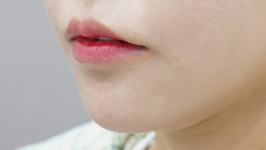 before filler treatment for downturned lips