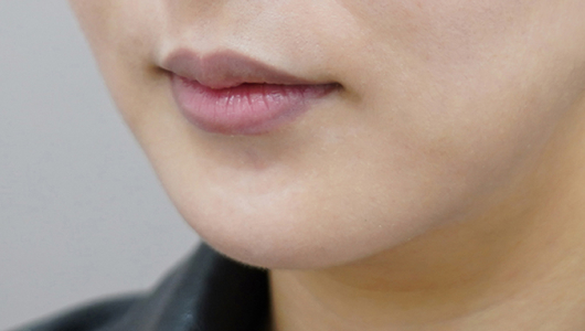 before filler treatment for uneven lips