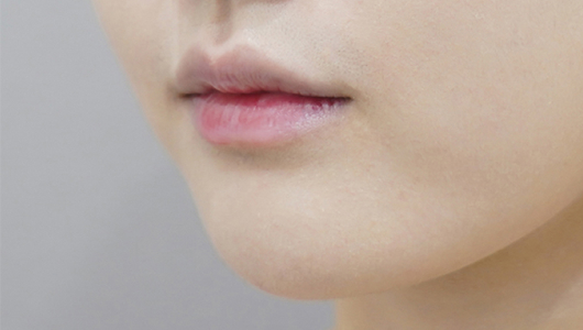 before filler treatment for small lips
