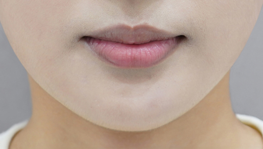 before filler treatment for curled-in lips