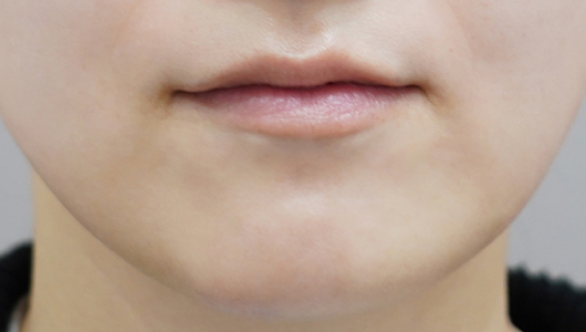 before filler treatment for a long philtrum