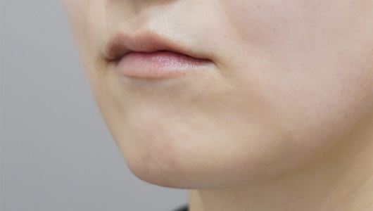 before filler treatment for a long philtrum