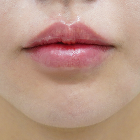 after filler treatment for downturned lips
