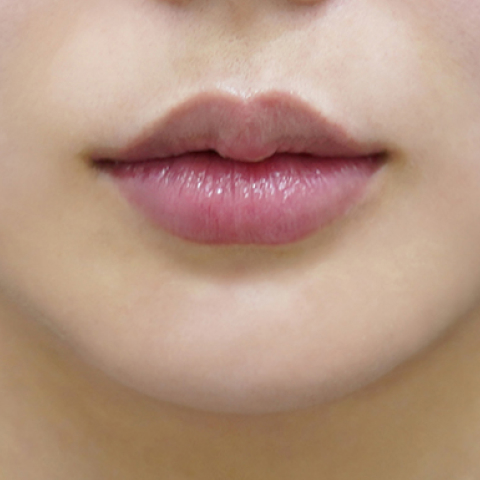 after filler treatment for uneven lips