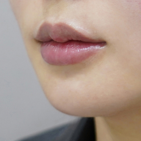 after filler treatment for uneven lips
