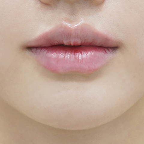 after filler treatment for small lips