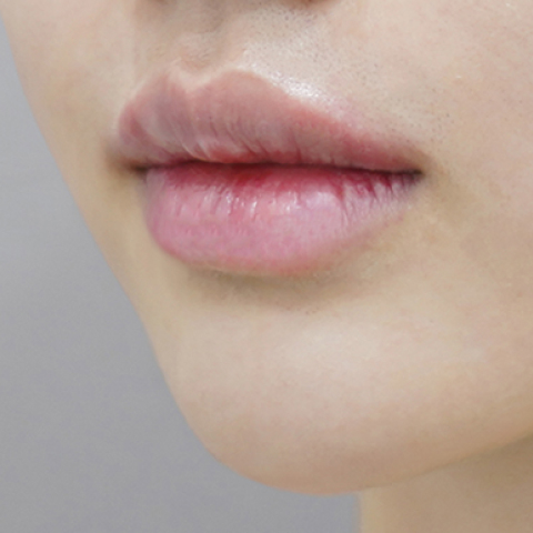 after filler treatment for small lips