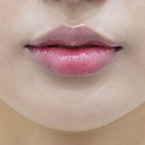 after filler treatment for curled-in lips