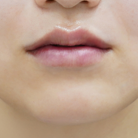 after filler treatment for a long philtrum