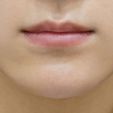 before filler treatment for thin lips