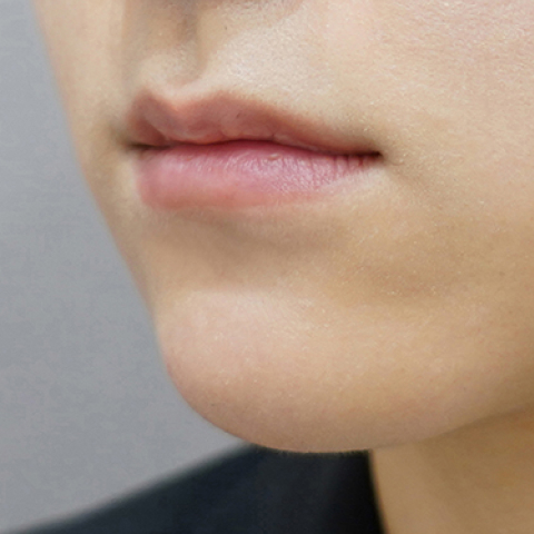before filler treatment for thin lips