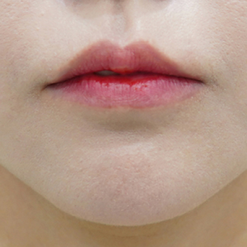 before filler treatment for downturned lips