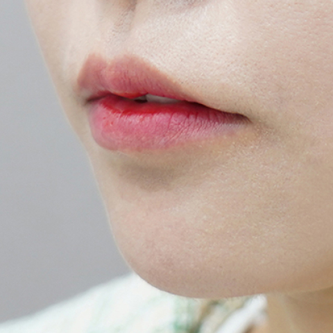 before filler treatment for downturned lips