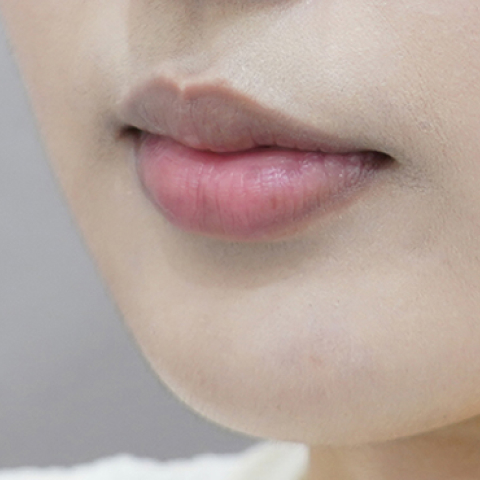 before filler treatment for curled-in lips