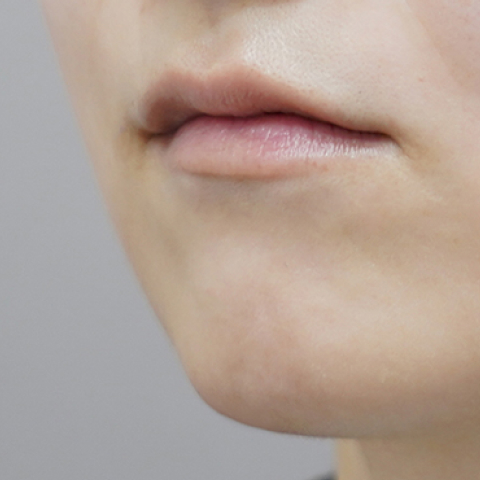 before filler treatment for a long philtrum