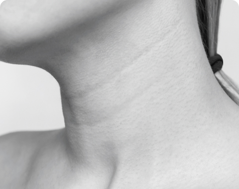 example of horizontal neck wrinkles