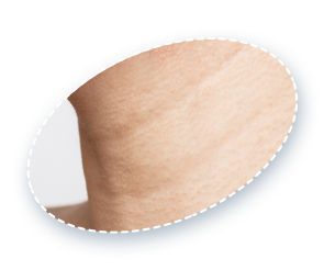 example of horizontal neck wrinkles