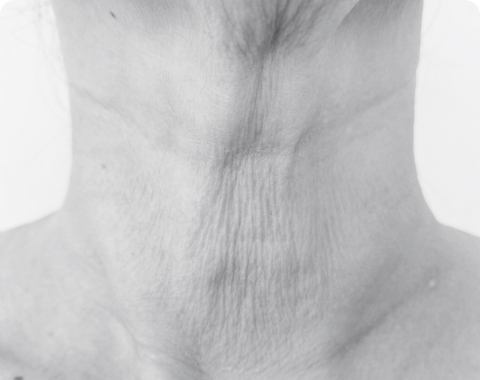 example of vertical neck wrinkles