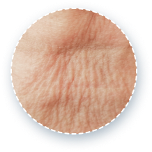 example of vertical neck wrinkles