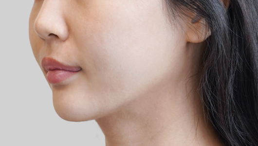 ONDA lifting face line after procedure image 1