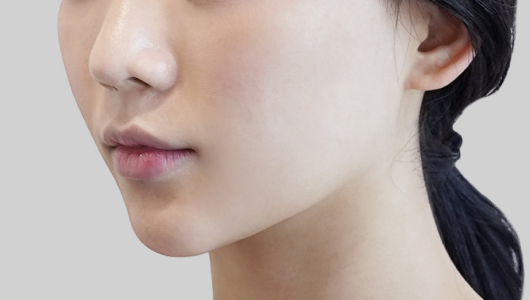 ONDA lifting face line after procedure image 2