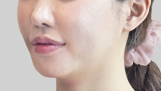 ONDA lifting face line after procedure image 3