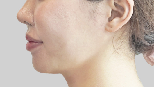 ONDA lifting face line after procedure image 4