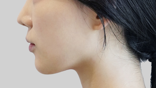 ONDA lifting face line after procedure image 5