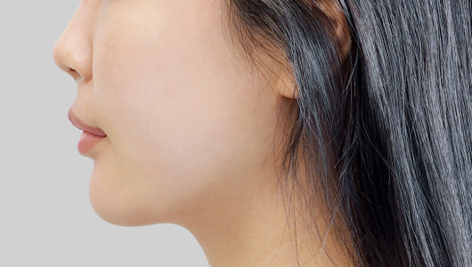 ONDA lifting face line after procedure image 6