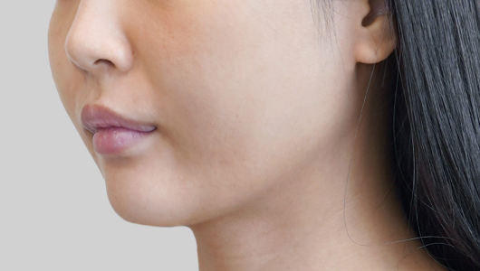 ONDA lifting face line before procedure image 1