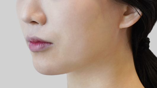 ONDA lifting face line before procedure image 2